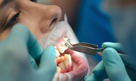 lower lingual holding arch